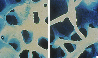 Normal Bone vs. Osteoporotic Bone Histology